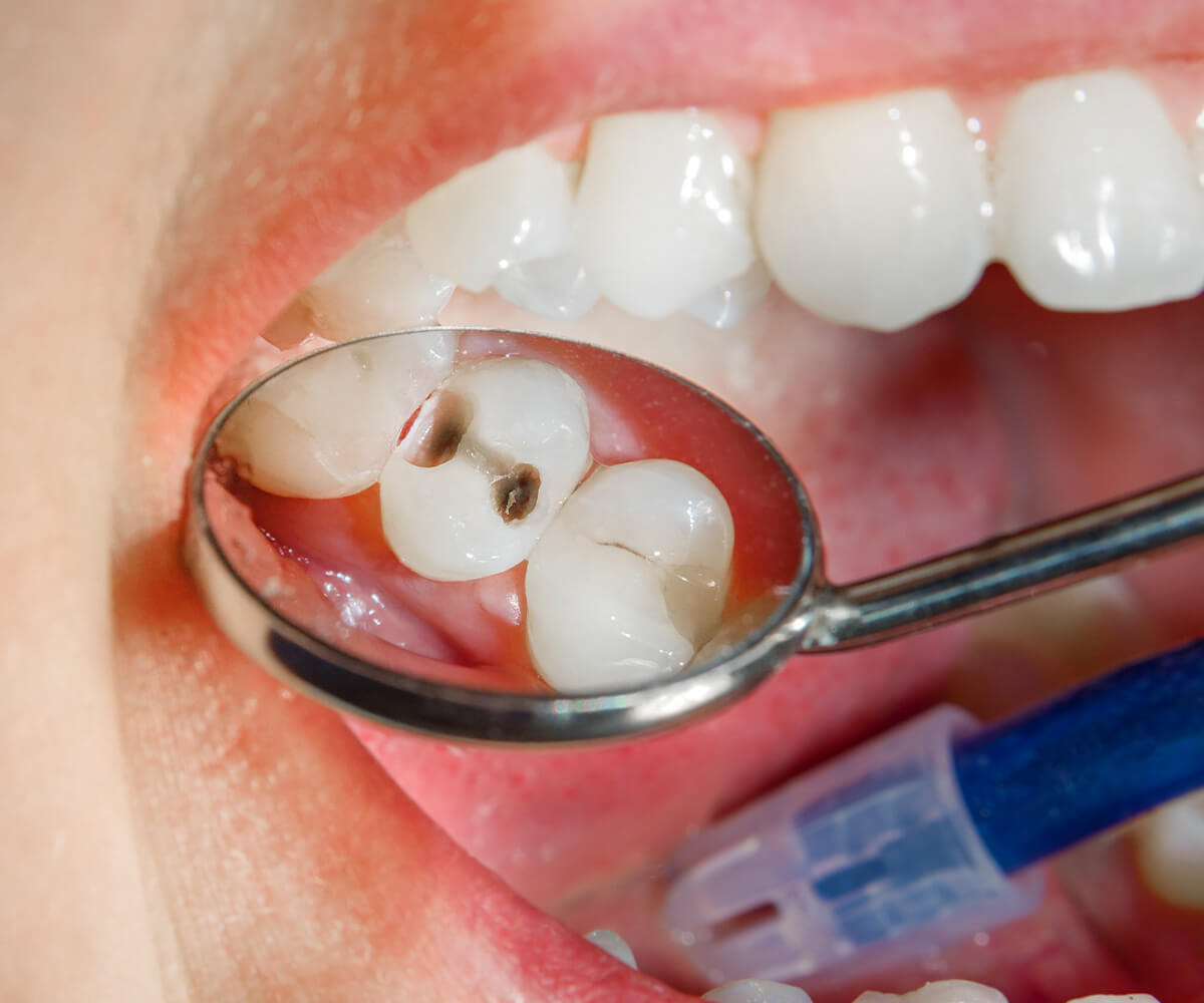 Carii-dentare