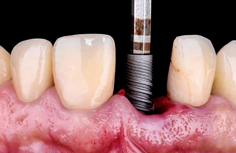 Instrucțiuni-post-operatorii-dupa-intervenții-chirurgicale-de-inserare-a-implaturilor-dentare-sau-adiției-osoase