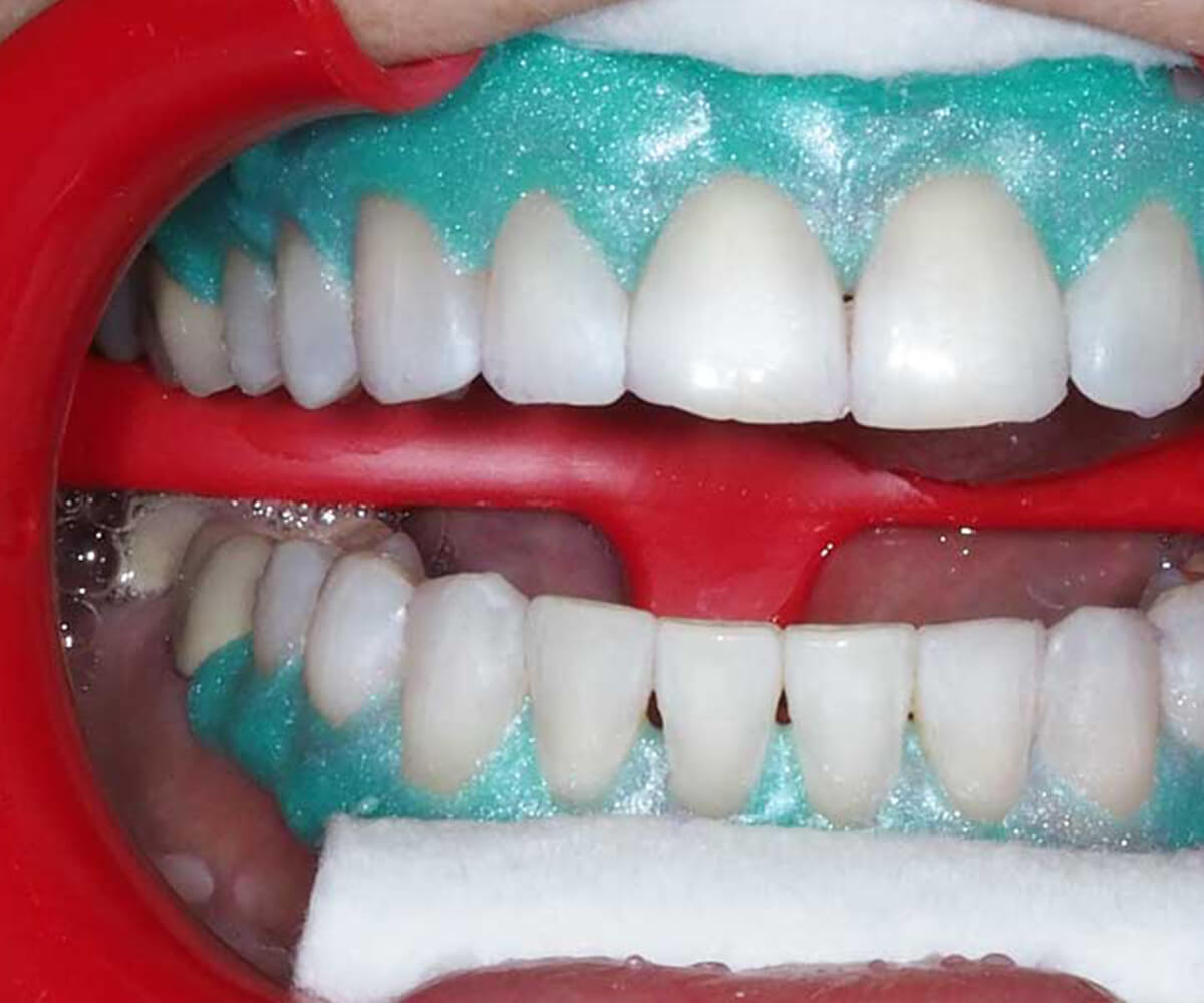 albire-dentara
