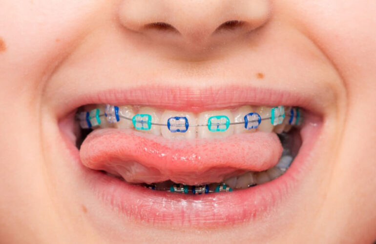 aparate-dentare-copii