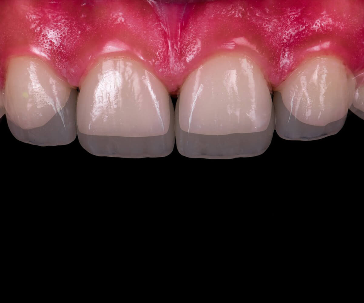fatete-dentare